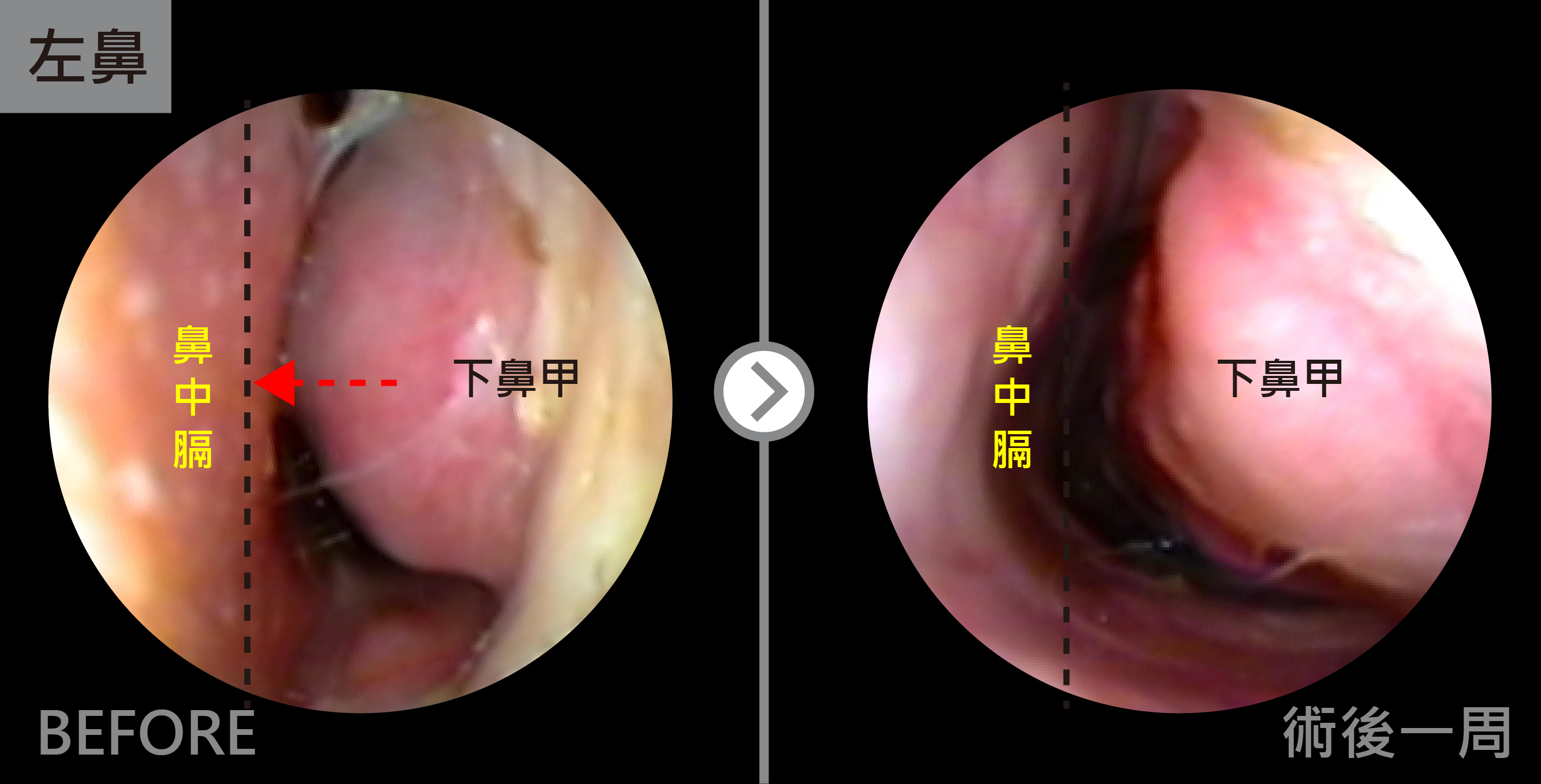  廣達雷射術後一周，傷口還有點結痂，但已經能明顯感受到呼吸比較順暢。