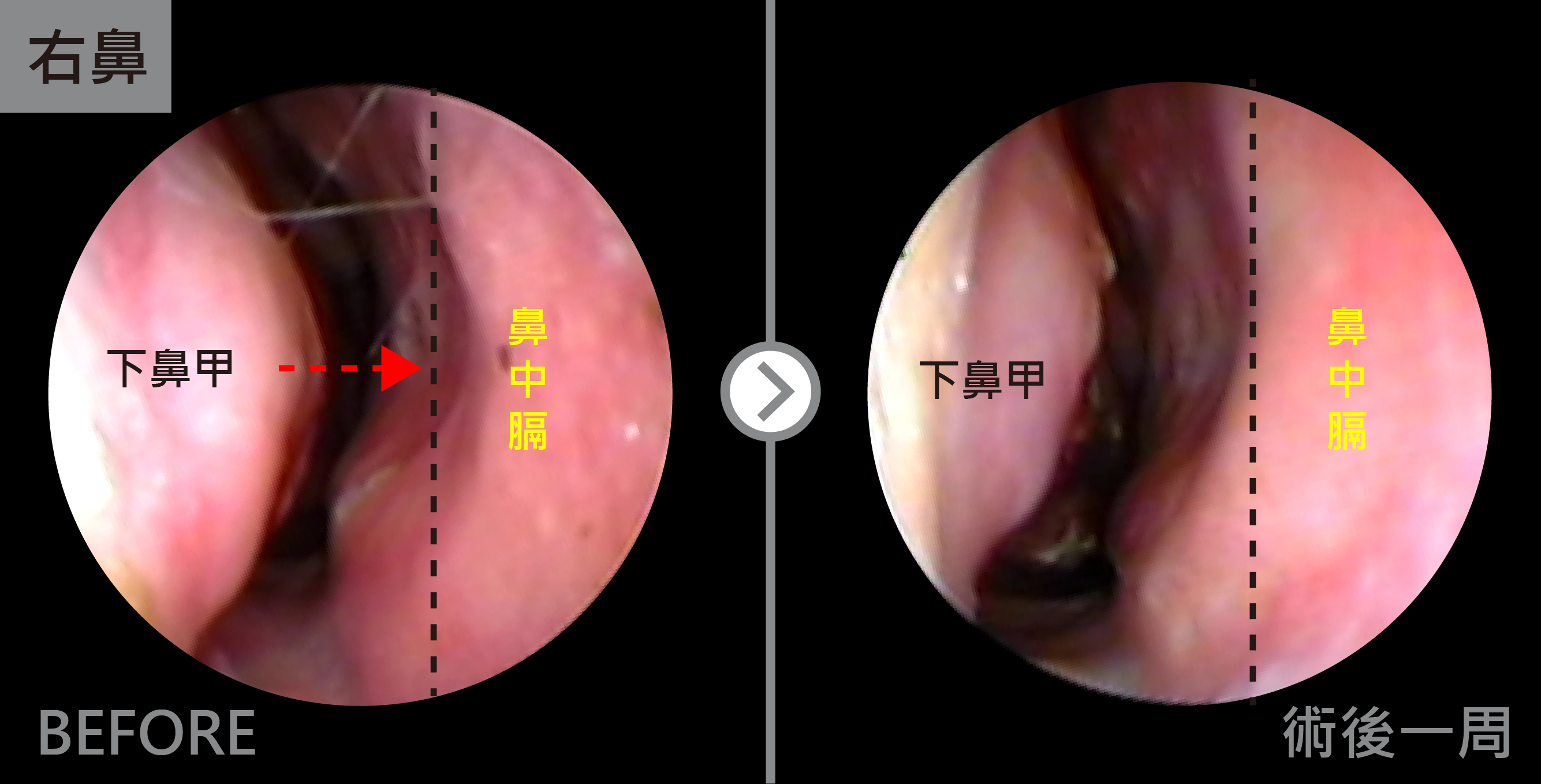 這是術後鼻內視鏡檢查