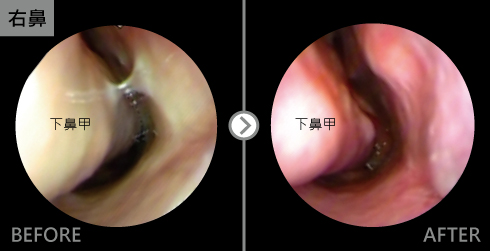 此案例是嚴重的過敏性鼻炎，在內視圖上下鼻甲黏膜呈現典型的水腫、蒼白的現象經下鼻甲微創手術及廣達雷射後，體積減小且下鼻甲黏膜的顏色也呈現正常的顏色。