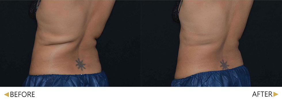 術後4週，背部脂肪減少，實際案例因人而異。
