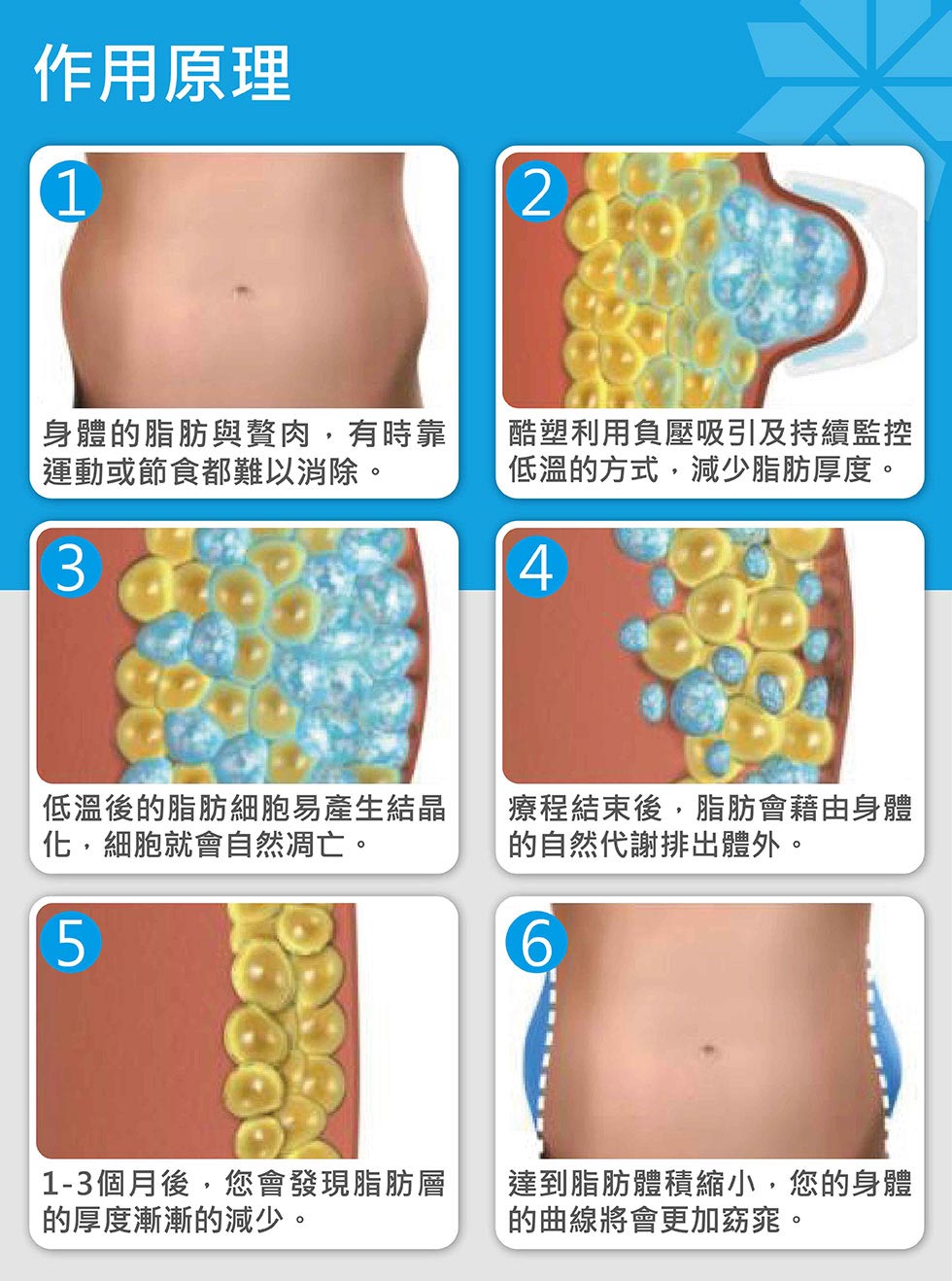 酷塑冷凍減脂CoolSculpting 作用原理