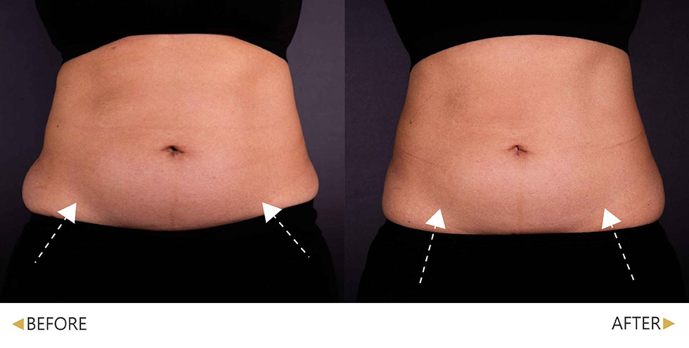 EMSCULPT NEO熱磁減脂經四次後緊實肌膚、減少脂肪(腹部)，實際效果因個案而異。