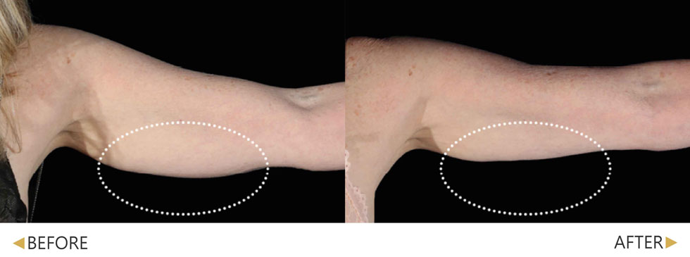 EMSCULPT NEO熱磁減脂經四次後緊實肌膚、減少脂肪(三頭肌)，實際效果因個案而異。