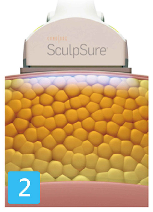 SculpSure將脂肪細胞加熱至42-47°C，破壞脂肪細胞；同時接觸式冷卻系統TM在治療中保護皮膚安全和維持舒適度。