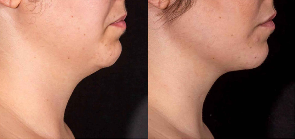 兩次治療12週後，雙下巴脂肪減少，實際效果因個案而異。