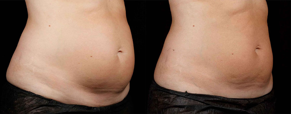 一次治療6週後，減少脂肪、腹圍減少，實際效果因個案而異。