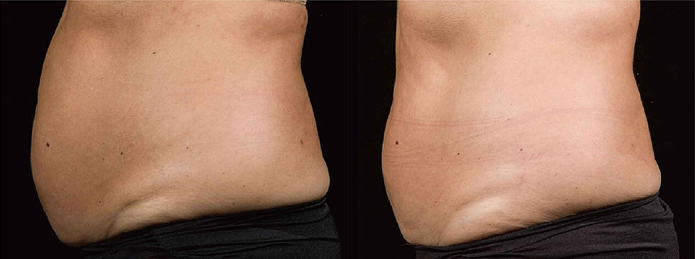兩次治療12週後，減少脂肪、腰圍減少，實際效果因個案而異。