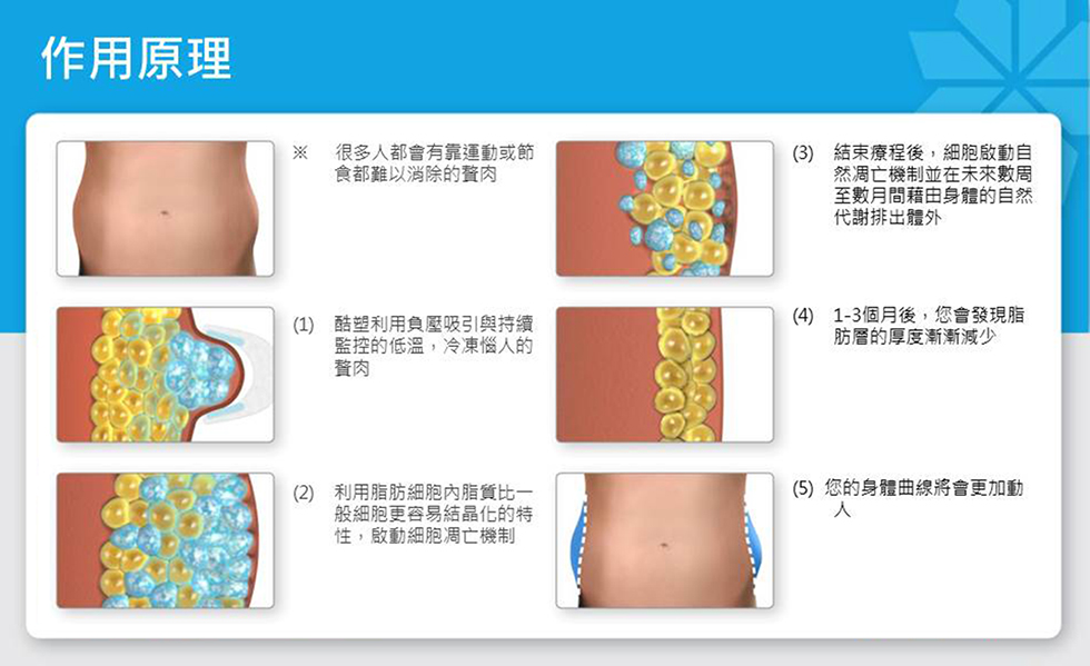 CoolSculpting冷凍減脂 作用原理