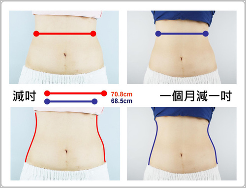 【iSKIN盧靜怡院長親自體驗】酷爾塑平冷凍減脂後腰圍變細自70.8cm縮68.5cm，一個月重現小蠻腰，整體感覺變瘦變美！（效果因個案而異）