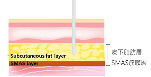 MINT神力拉提，將套管插入SMAS 層中一定深度(穿過皮下脂肪層)。