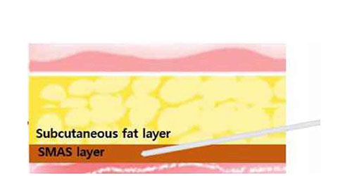 MINT神力拉提，套管沿著與皮膚平行的方向穿過SMAS 筋膜層和皮下脂肪層。