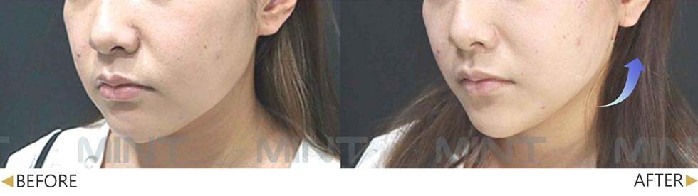 MINT神力拉提，上提鬆弛的雙頰，同時改善嘴角紋及修飾下面部輪廓線。(實際效果因個案而異)