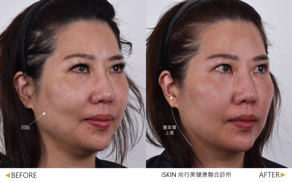 術前臉頰顴骨下方塌陷，術後1個月側頰滑順澎潤，肌膚緊緻度提升(實際效果因人而異)