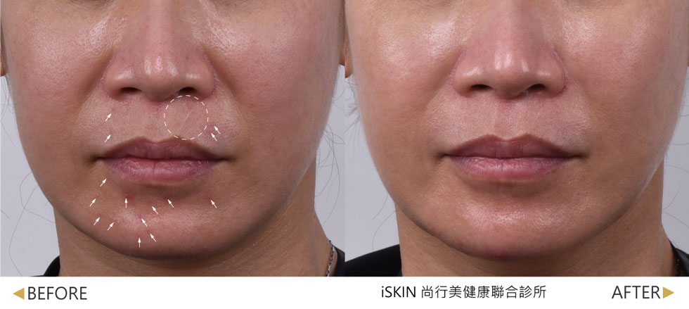搭配導入傳明酸精華，術後沉澱痘疤色素明顯淡化，毛孔更細緻，整體膚色更為勻亮。(實際效果因個案而異)