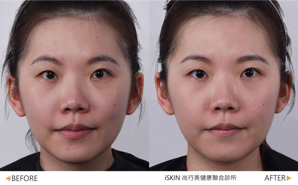 鳳凰光搭配麗珠蘭(白瓷)導入，術後眼下暗沉，黑眼圈及雀斑獲得明顯改善。(實際效果因個案而異)
