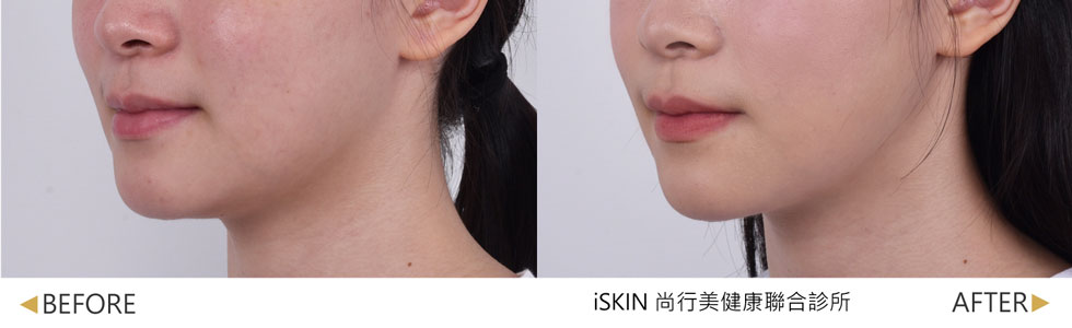4次治療1週後效果，後續持續治療中，雙下巴脂肪減少、下顎線輪廓較緊實(實際效果，因人而異)。