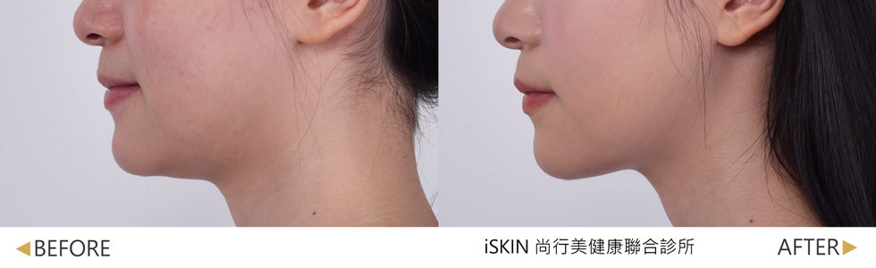4次治療1週後效果，後續持續治療中，雙下巴脂肪減少、下顎線輪廓較緊實(實際效果，因人而異)。