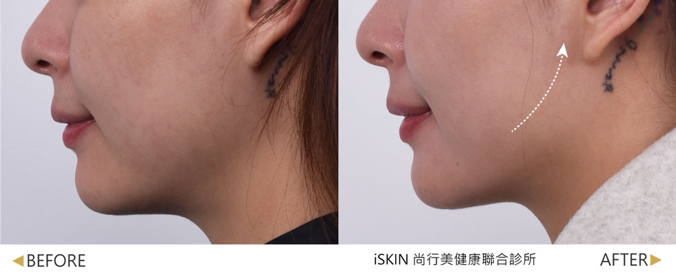 複合式療程專案-【菲斯波EMFACE 1次】--蘋果肌位置拉提、木偶紋明顯淡化 +【玻尿酸淚溝1cc】--改善淚溝凹陷、眼周老態，使整體輪廓自然拉提、淚溝飽滿，氣色佳。(實際效果因個案而異)