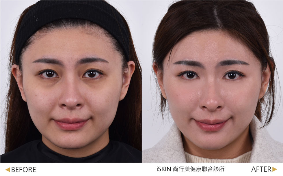 複合式療程專案-【菲斯波EMFACE 1次】--蘋果肌位置拉提、木偶紋明顯淡化 +【玻尿酸淚溝1cc】--改善淚溝凹陷、眼周老態，使整體輪廓自然拉提、淚溝飽滿，氣色佳。(實際效果因個案而異)