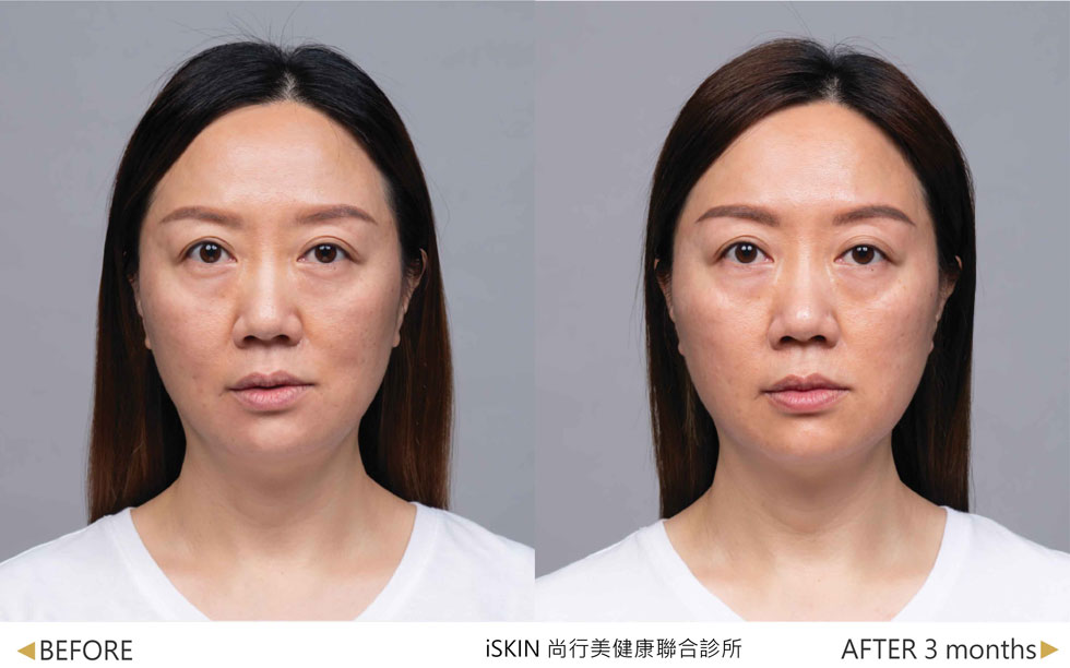媄神針術後下臉輪廓更緊實，更顯年輕 (實際效果，因人而異)。