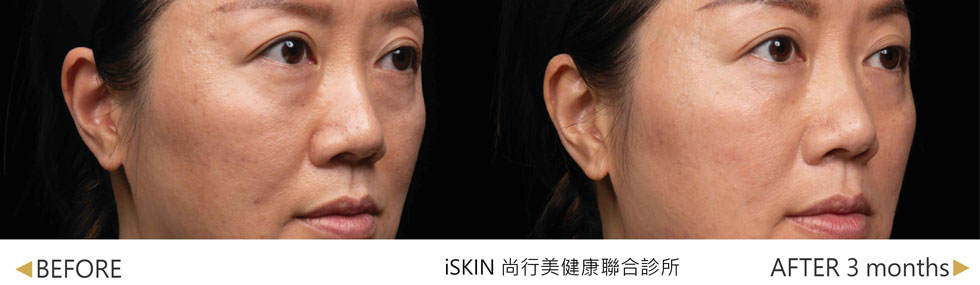 媄神針術後臉部中段更澎彈緊緻 (實際效果，因人而異)。