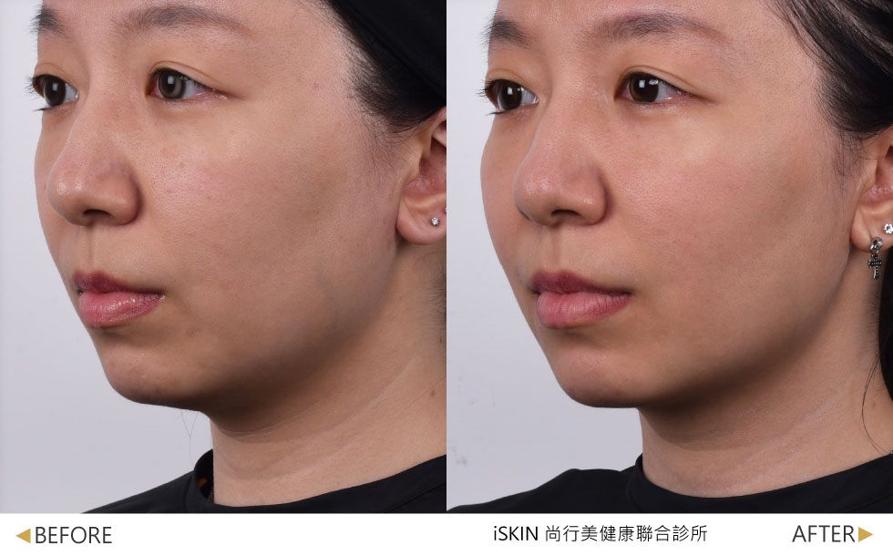 術前下顎輪廓模糊，術後肌膚支撐力及緊實度提升，輪廓線條較為俐落 (實際效果，因人而異)。