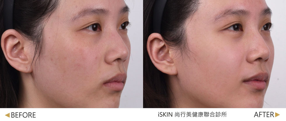 媄神針術後中臉較為澎彈緊緻，改善蘋果肌下垂及容積流失(實際效果，因人而異)。