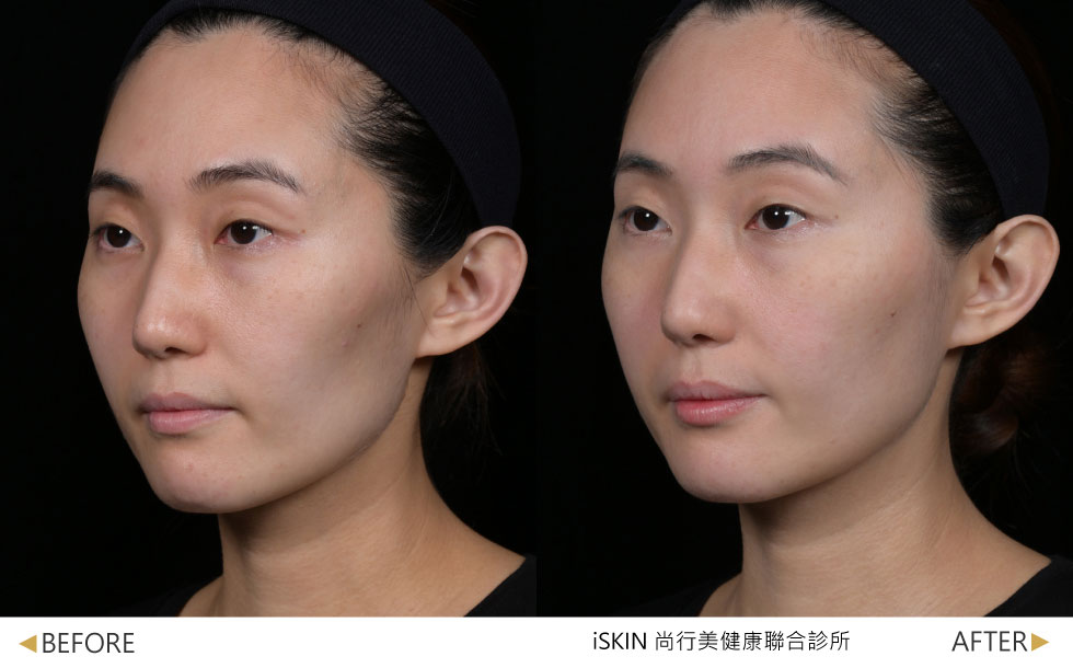 術後改善側頰凹陷輪廓線條順暢，淡化嘴角紋路，整體年輕緊緻感提升(實際效果，因人而異)。
