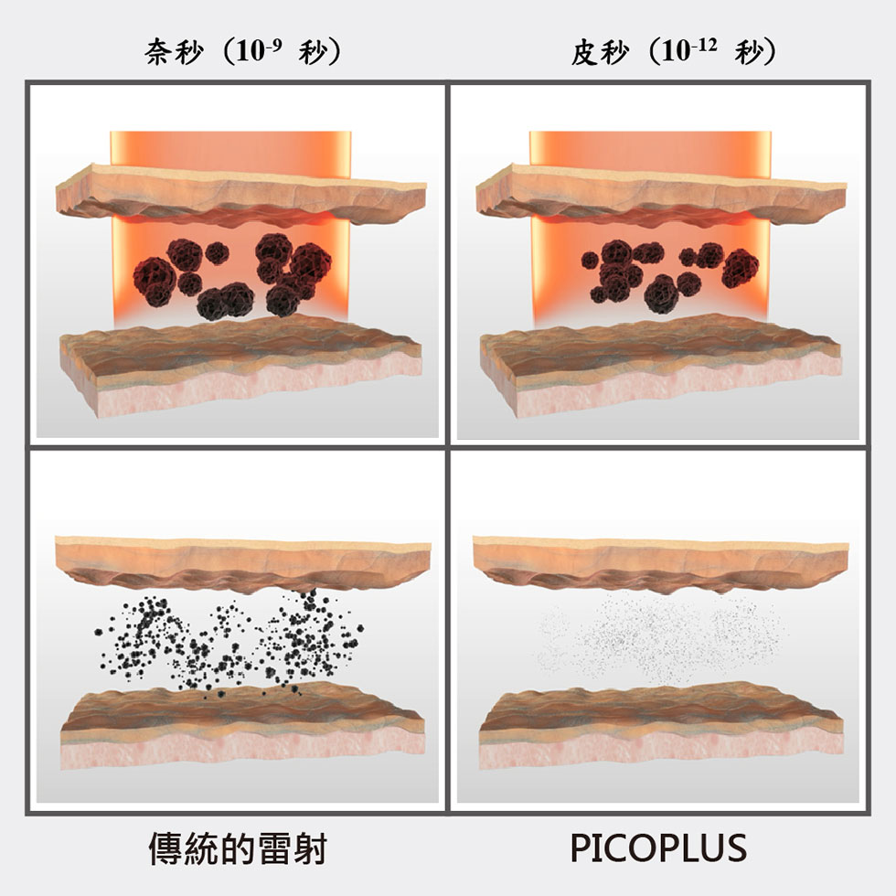 4D皮秒雷射PICO PLUS (蜂巢皮秒雷射)能將色素斑塊擊碎成粉塵，能更快代謝出體外。實際效果因人而異，建議先經由專業醫師諮詢。