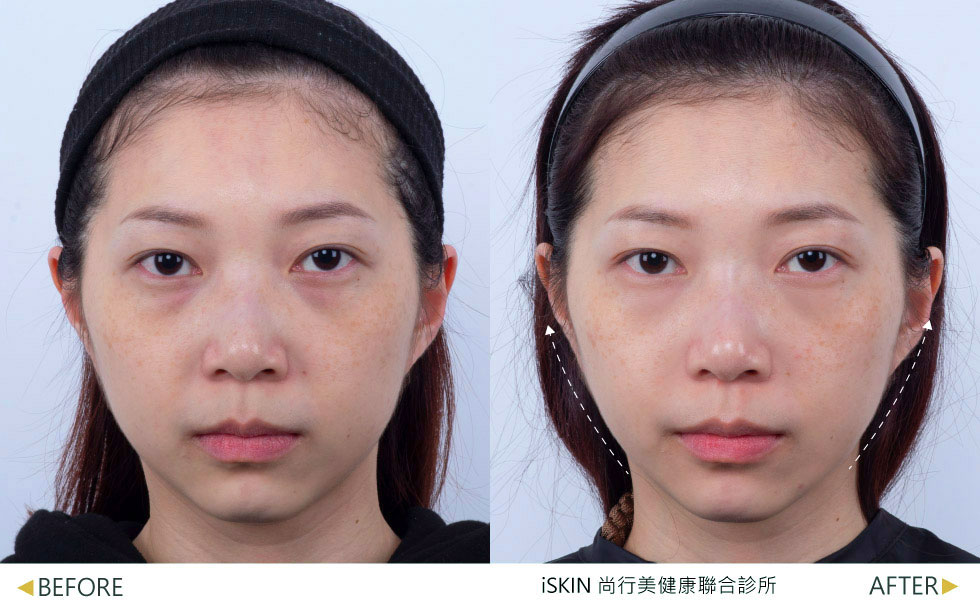 治療一次效果，術後三個月，全臉緊緻、改善輪廓線，讓臉部線條更立體精緻，並淡化黑色素，實際效果因個案而異。