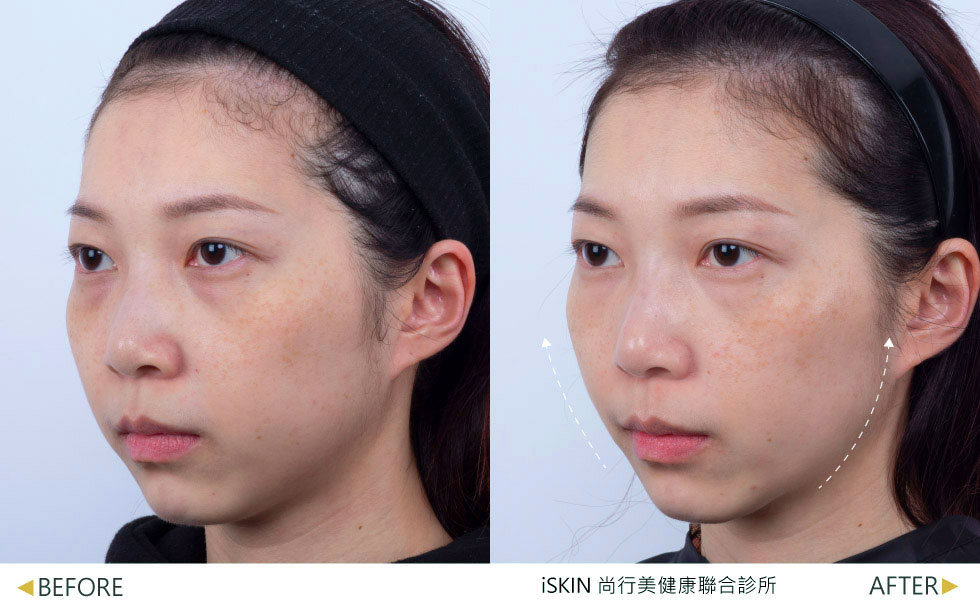 治療一次效果，術後三個月，全臉緊緻、改善輪廓線，讓臉部線條更立體精緻，並淡化黑色素，實際效果因個案而異。