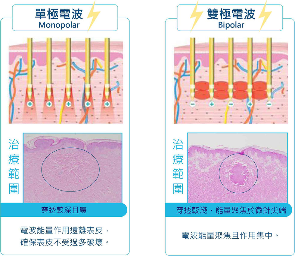 無限電波同時具有單極電波及雙極電波，一次處理深淺層問題。