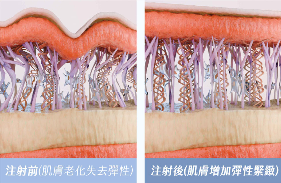 BAP技術（生物美學點）-五點注射將成分直接帶入治療區域，同時活化肌膚多層次，增加彈性跟緊緻度，預防老化發生和從底層治療鬆弛的皮膚。