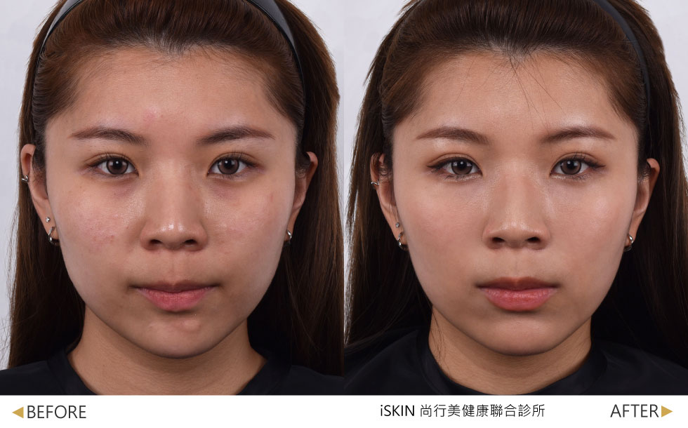 術前中面部扁平，術後蘋果肌較為澎潤、法令紋淡化，視覺立體感提升，整體看起來更緊實精緻(實際效果，因人而異)。