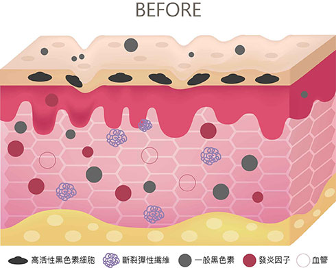 治療前：皮下組纖同時出現發炎、色素沈澱、光老化等現象。
