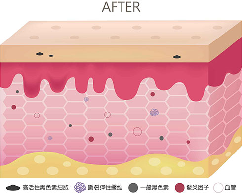 治療後：真皮層厚度增加，減少黑色素細胞、降低發炎、改善光老化。