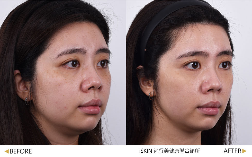 複雜型深淺層(曬斑、肝斑、顴骨母斑)：3次治療術後一個月，PICOSURE PRO+煥彩皮秒+外泌體，打散深層斑，淺層斑明顯淡化，再搭配外泌體，可加速術後修復，同時優化療程效果，實際效果因個案而異。