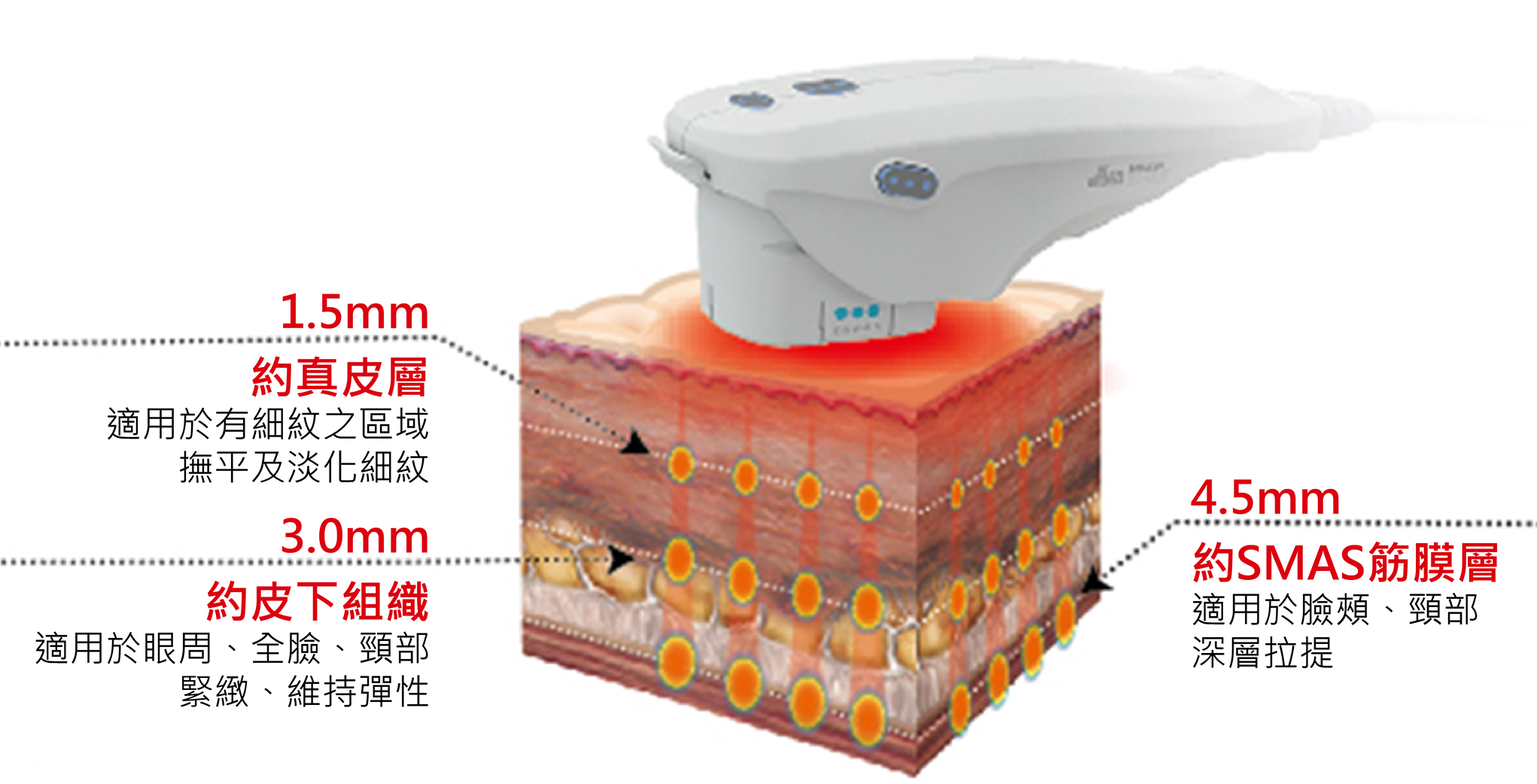 Ultherapy的探頭名稱是“Transducer”超音波能量傳導器，目前有三種深度的Transducer︰4.5mm/3.0mm/1.5mm，主要差異在於治療深度與治療能量點的長度，全臉治療通常建議使用兩種以上深度的transducer，達到深淺兩層作用療效，發數分配可依照醫師的判斷及病患需求選用。