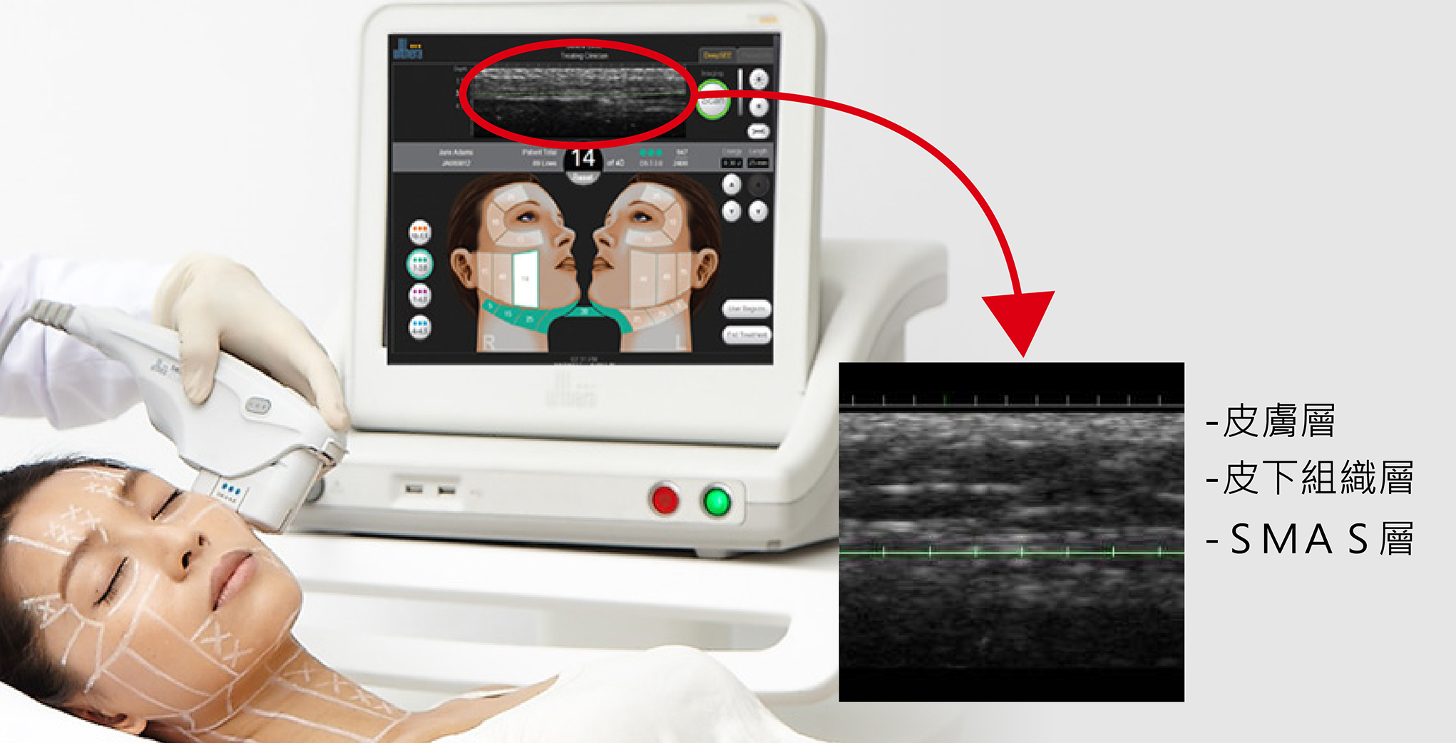 醫師會使用超音波系統的超音波顯像系統去觀察病患皮膚下的情況，並且規劃最佳治療位置。
