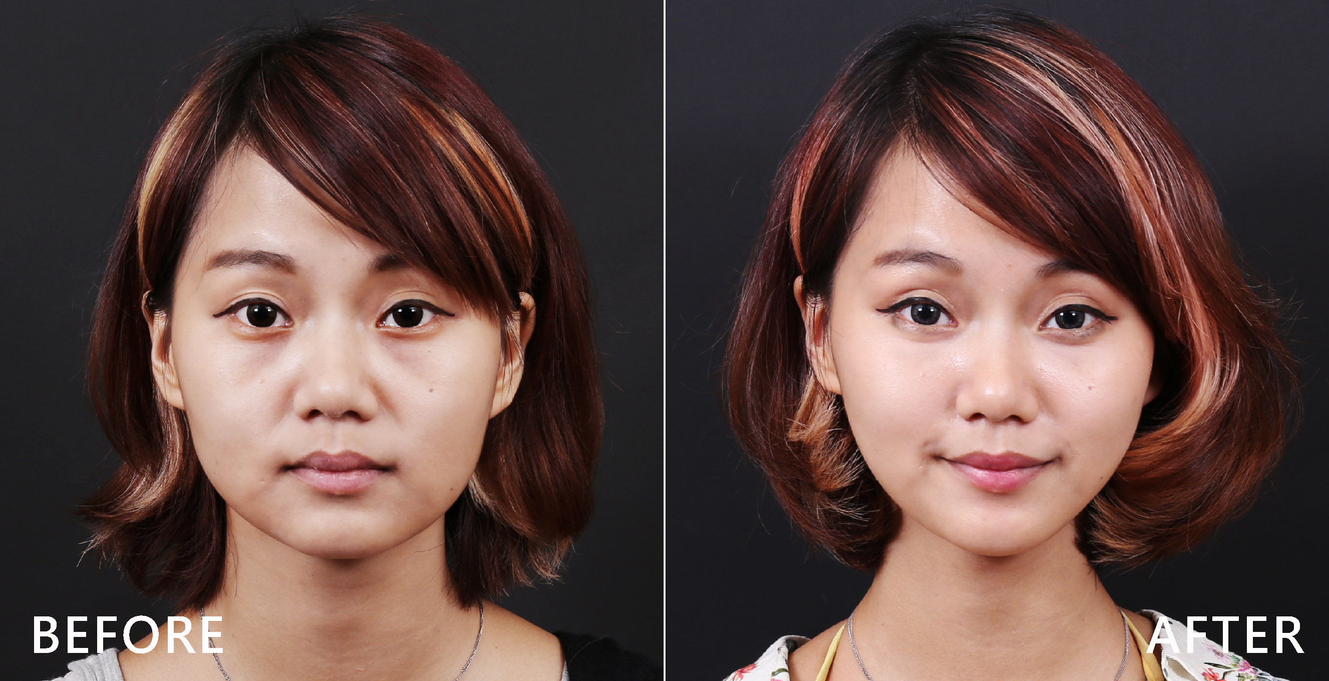 施打完除皺瘦臉針後讓臉部線條更立體。(本療程施打效果因人而異)