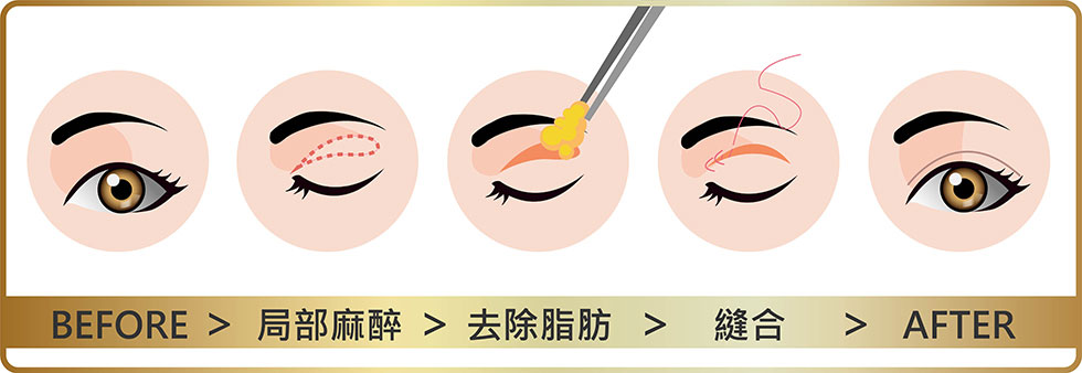 縫雙眼皮傷口小恢復快，割雙眼皮傷口較大但維持較久，醫師會視個人狀況而給予建議。
