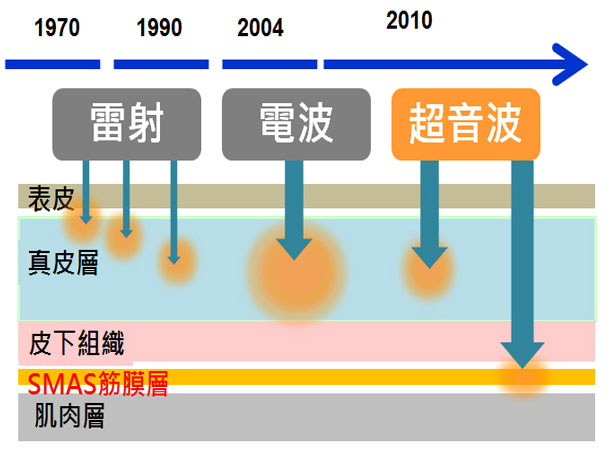 Laser（雷射）及RF（Radiofrequency, 無線射頻）能量過高時，可能會出現表皮燙傷的風險。Laser及RF作用並無法達到SMAS筋膜層位置。