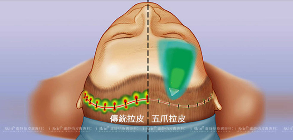 左為傳統的拉皮方式，需沿著髮髻線平行開口、縫合，傷口範圍大，且縫合點的壓力強； 右以五爪鉤進行垂直方向的拉提，藉鉤爪把額頭或中臉的老化贅肉提起，單一切口僅2～3公分，固定力道穩定、壓力分布平均。