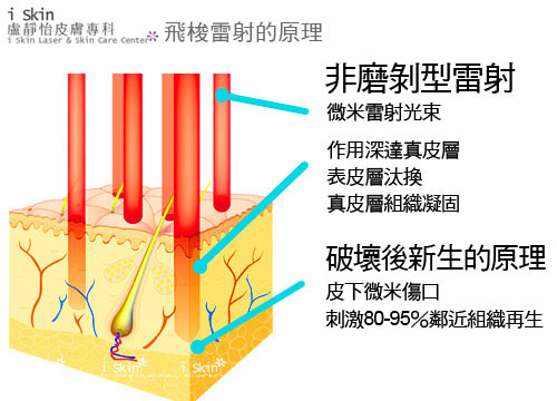 飛梭雷射的原理圖