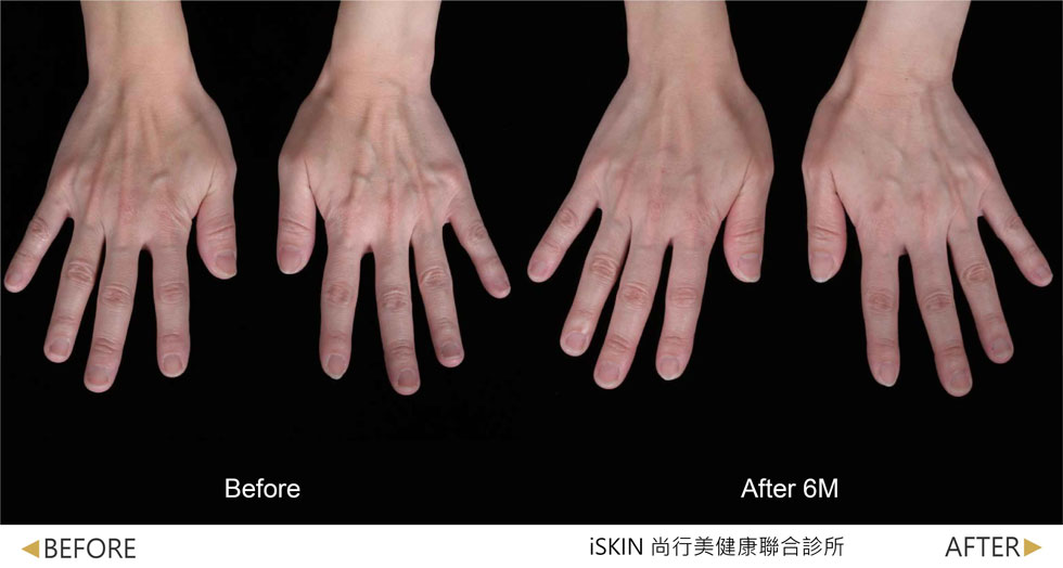 以Volite劑型治療,手背肌膚澎潤度提升,皺紋撫平並改善因皮膚萎縮而突出的青筋。 (實際效果因人而異)