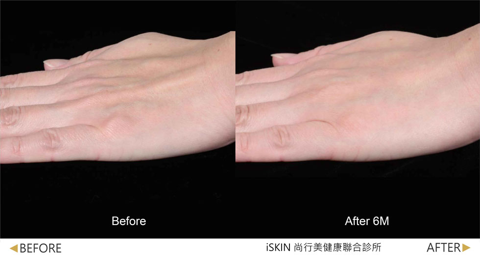 以Volite劑型治療,手背肌膚澎潤度提升,皺紋撫平並改善因皮膚萎縮而突出的青筋。 (實際效果因人而異)