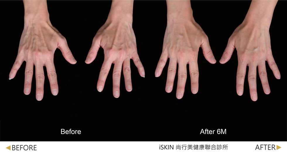 以Volite劑型治療,手背肌膚澎潤度提升,皺紋撫平並改善因皮膚萎縮而突出的青筋。 (實際效果因人而異)