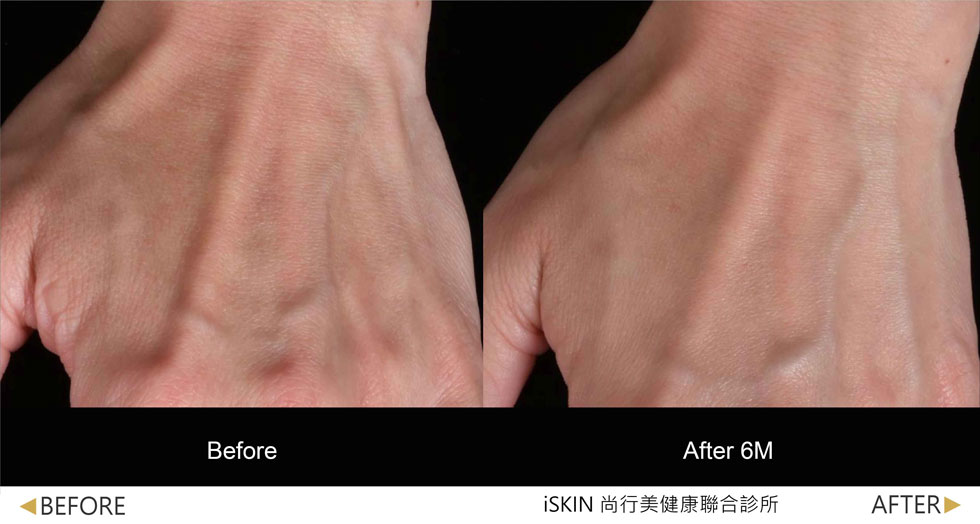 以Volite劑型治療,手背肌膚澎潤度提升,皺紋撫平並改善因皮膚萎縮而突出的青筋。 (實際效果因人而異)
