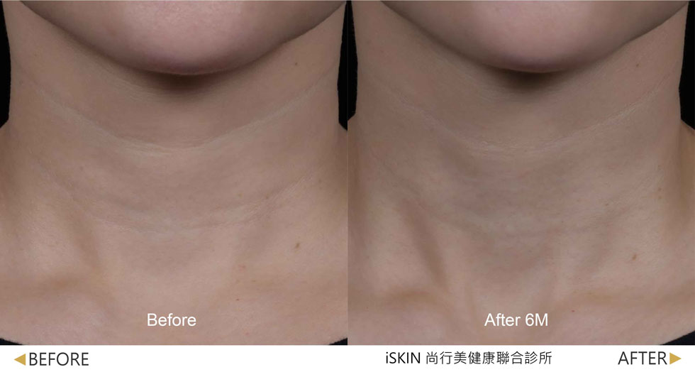 以Volite劑型治療,脖紋線條明顯淡化,肌膚質感細緻度提升 (實際效果因人而異)