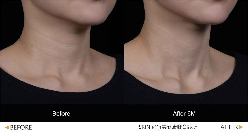 以Volite劑型治療,脖紋線條明顯淡化,肌膚質感細緻度提升 (實際效果因人而異)
